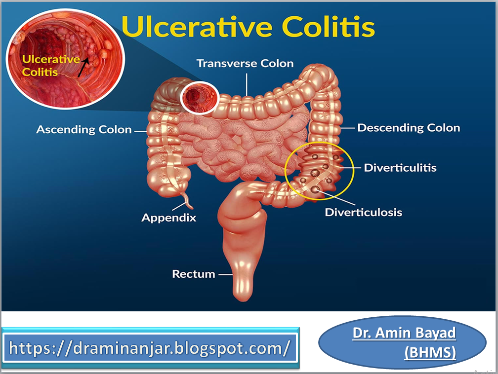 Bowel Ulcers Signs And Symptoms - UlcerTalk.com