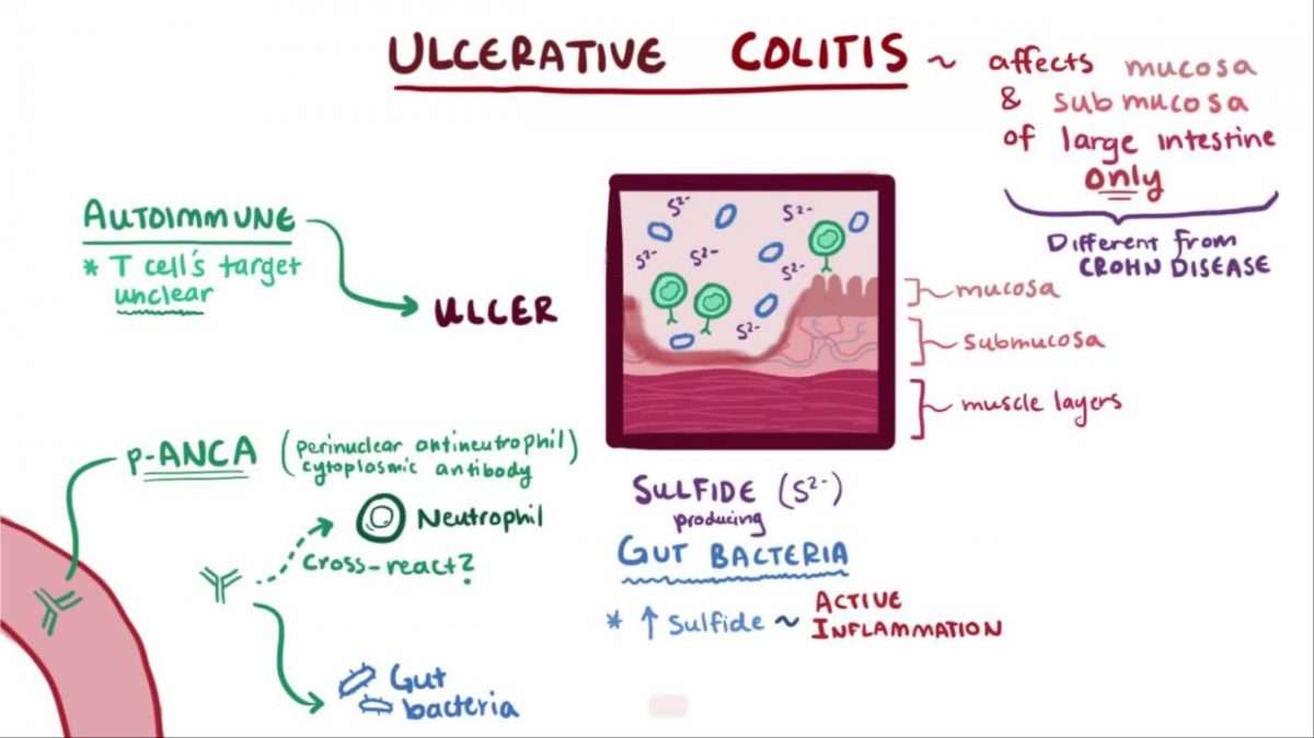 acute-exacerbation-ulcerative-colitis-symptoms-ulcertalk